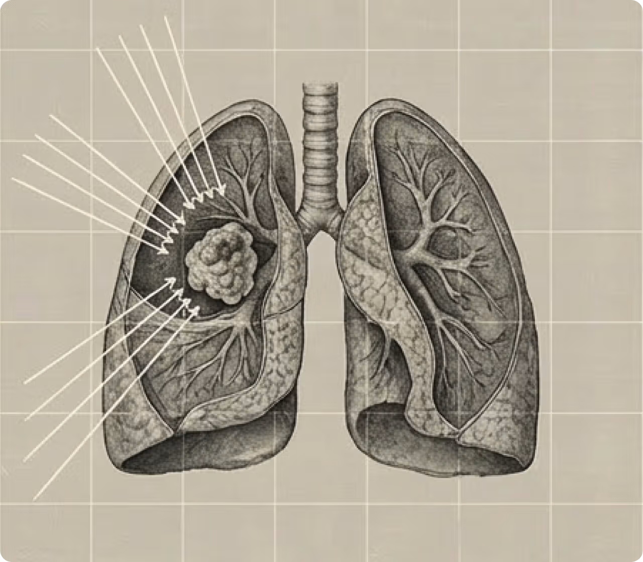 Medical illustration of lungs with a tumor in the right lung, highlighted by radiating lines pointing to the mass, on a grid background